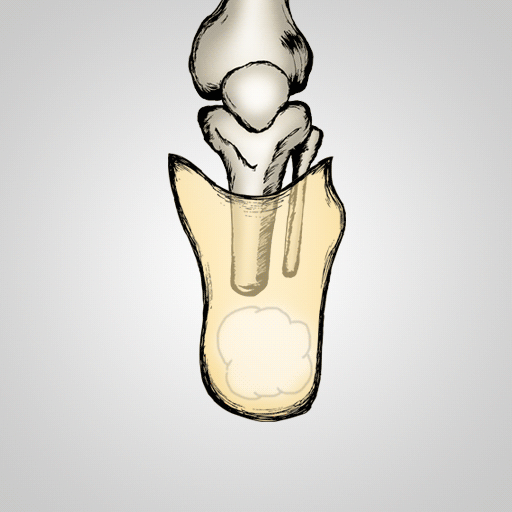 Vacuum Assisted Suspension Transtibial Socket Finder